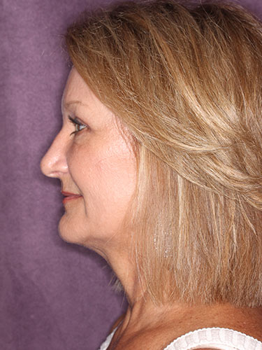 Case--32616 | After Eyelid Surgery (Blepharoplasty) 4