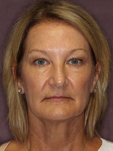 Case--32616 | Before Eyelid Surgery (Blepharoplasty) 1