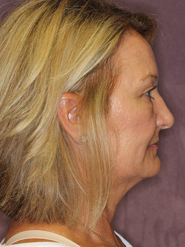 Case--32616 | Before Eyelid Surgery (Blepharoplasty) 3